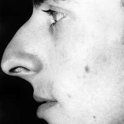 rhinoplastie_001-homme_avant