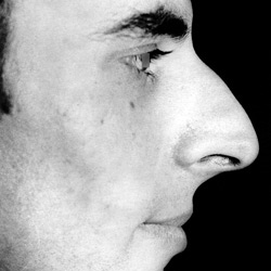 rhinoplastie_002-homme_avant