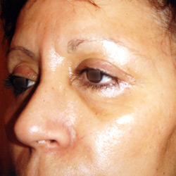 blepharoplastie_001_apres