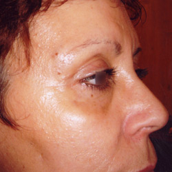 blepharoplastie_002_apres