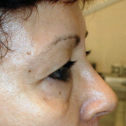 blepharoplastie_002_avant