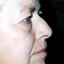 blepharoplastie_004_avant