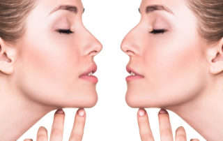 Visage-Rhinoplastie Dr Thierry Aboudaram