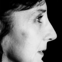La rhinoplastie - Dr Thierry Aboudaram Chirurgien Esthétique