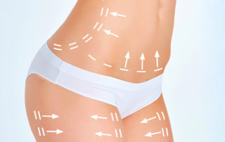 Silhouette-BodyLift Dr Thierry Aboudaram